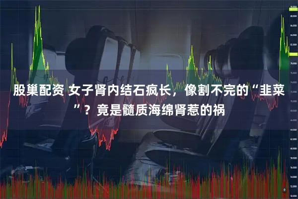 股巢配资 女子肾内结石疯长，像割不完的“韭菜”？竟是髓质海绵肾惹的祸